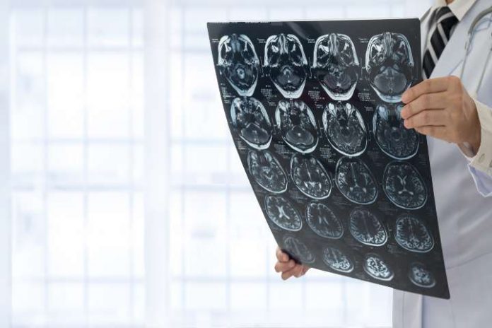 Come Capire Se Hai Un Tumore Al Cervello